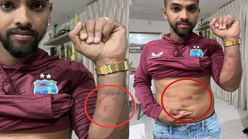 Nicholas Pooran shares images of bruises after Arshdeep Singh's delivery and Brandon King's shot